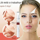 Warebrill™ - Removedor de Rugas e Marcas de Nascença