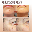 Warebrill™ - Removedor de Rugas e Marcas de Nascença