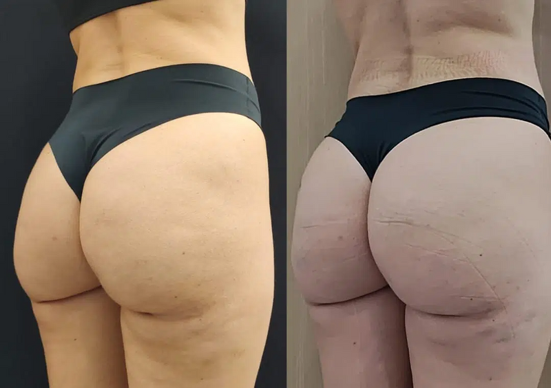 Creme Crescimento do bumbum- HIP UP